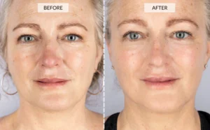 LED Light Therapy Face Mask  before and after 