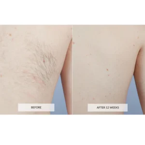Laser Hair Removal Device