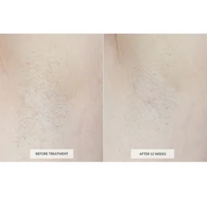 Laser Hair Removal Device