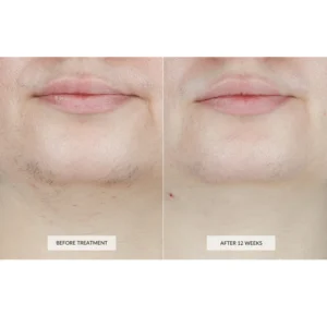 Laser Hair Removal Device